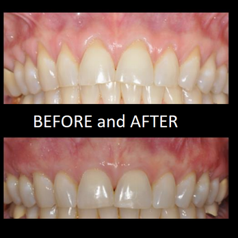 Michael A Nguyen DDS MS - Soft Tissue Grafting was done to treat the gum recession. - Periodontists Near Me - Los Altos, California Michael A Nguyen DDS MS - Soft Tissue Grafting was done to treat the gum recession. - Periodontists Near Me - Los Altos, California