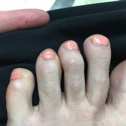 Bad pedicure. Sloppy polish and bad shaping.