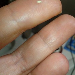 Brush Dental - 1 of 5 bone spurs!