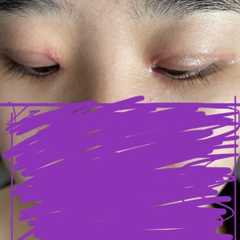 Dr. Kenneth Kim Plastic Surgery - After surgery but having scar tissues. - Plastic Surgeons Near Me - Los Angeles, California Dr. Kenneth Kim Plastic Surgery - After surgery but having scar tissues. - Plastic Surgeons Near Me - Los Angeles, California