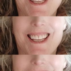 Cal Select Dental Group - After STUNNING didnt they do a great job?