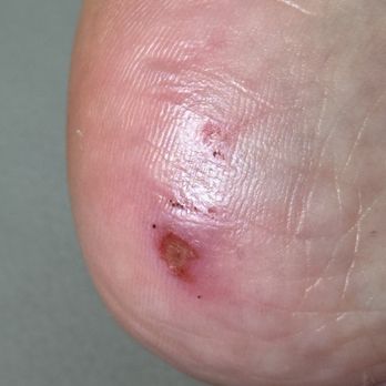 Filed Nails Spa Beauty - Heel infection - Nail Salons Near Me - Edmond, Oklahoma