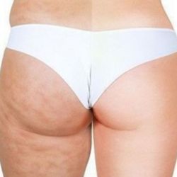 Consult Your Image - Cellulite Reduction