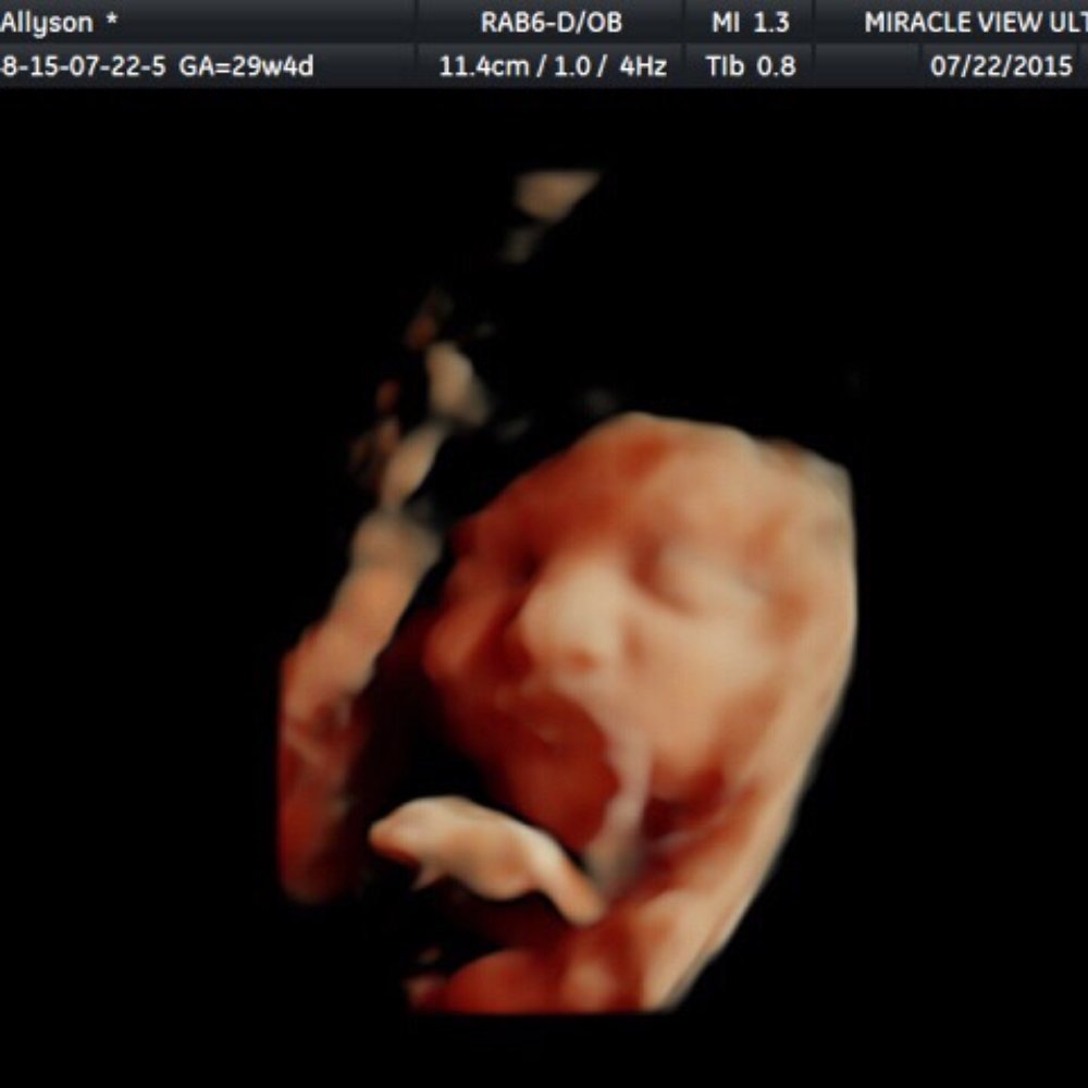 Miracle View 3D/4D Ultrasound - Obstetricians & Gynecologists Near Me - Phoenix, Arizona Miracle View 3D/4D Ultrasound - Obstetricians & Gynecologists Near Me - Phoenix, Arizona