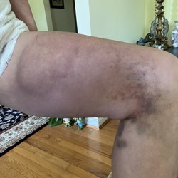 Muddy Water Equestrian - Here is what her injury looks like 19 days later. A volunteer called to check on her a few days after, but the owner has not reached out.
