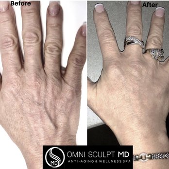 Omni Sculpt MD - Hand Rejuvenation using Radiesse - Medical Spas Near Me - Dallas, Texas