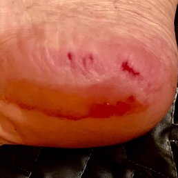 You can clearly see gauge marks into the soles of my feet. And the bleeding.