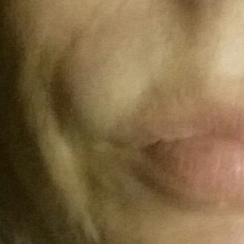 Cosmetic Laser Professionals MED SPA - Ball close up - Laser Hair Removal Near Me - Miami, Florida