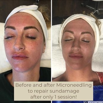 The GetAway Spa - Before and after just 1 session - Nail Salons Near Me - Punta Gorda, Florida The GetAway Spa - Before and after just 1 session - Nail Salons Near Me - Punta Gorda, Florida