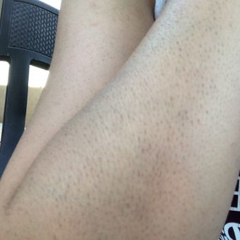 Advanced Laser Clinics - Laser Hair Removal Near Me - Glendale, Arizona Advanced Laser Clinics - Laser Hair Removal Near Me - Glendale, Arizona
