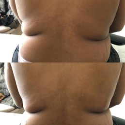 Bar area ,back bulge Bar area ,back bulge