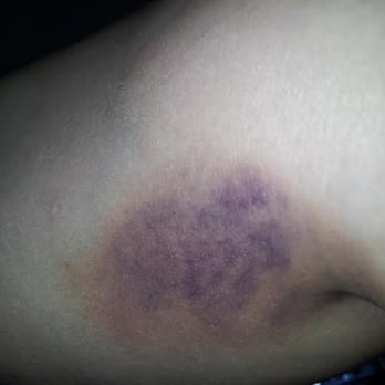 Pin Thai Massage - Hence, the bruise that I received on top of it all... - Massage Therapy Near Me - Honolulu, Hawaii Pin Thai Massage - Hence, the bruise that I received on top of it all... - Massage Therapy Near Me - Honolulu, Hawaii