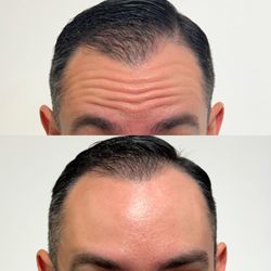 Before and after tox treatment