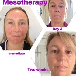 The Health & Vitality Clinic - Mesotherapy for rejuvenation and hydration
