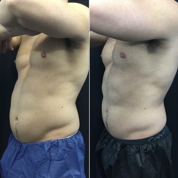Erasable Med Spa - Fat reduction and muscle building with truSculpt iD - Tattoo Removal Near Me - Tampa, Florida Erasable Med Spa - Fat reduction and muscle building with truSculpt iD - Tattoo Removal Near Me - Tampa, Florida