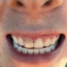 They left a piece of green material in my teeth after a procedure separating my teeth & gums with green material.