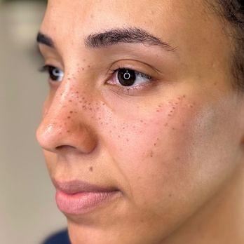 The Micro Clinics - Freckle Tattoo - Permanent Makeup Near Me - Orlando, Florida The Micro Clinics - Freckle Tattoo - Permanent Makeup Near Me - Orlando, Florida