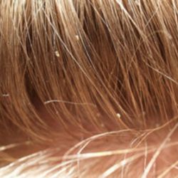 Pickem Lice Removal - Nits (Lice eggs)