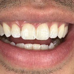 Ashby Dental in Elmwood - After diastema/front teeth gap closure