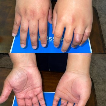 Shamrock Prosthetics - LivingSkins passive prosthesis for 3-digit amputee (Left Hand) - Prosthetics Near Me - Athens, Georgia Shamrock Prosthetics - LivingSkins passive prosthesis for 3-digit amputee (Left Hand) - Prosthetics Near Me - Athens, Georgia