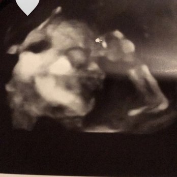 Peek A Baby - My ultrasound! - Ultrasound Imaging Centers Near Me - Fresno, California