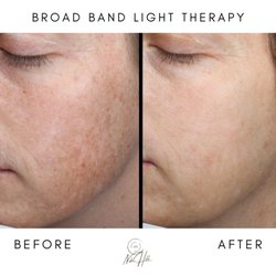 Nob Hill Aesthetics - Broad Band Light Therapy before and after