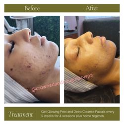 Crowned & Bougie Day Spa - Acne scar resurfacing