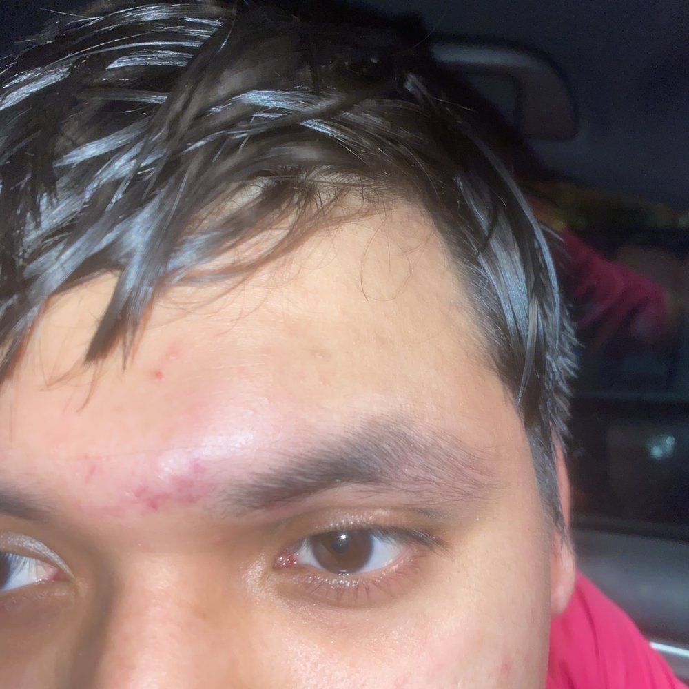 FXA Sports - My teammates forehead that got punched while he was trying to break up the "fight" - Sports Clubs Near Me - Chantilly, Virginia FXA Sports - My teammates forehead that got punched while he was trying to break up the "fight" - Sports Clubs Near Me - Chantilly, Virginia