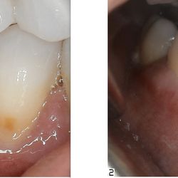 James Oh, DDS - Pinhole Gum Lifting Procedure