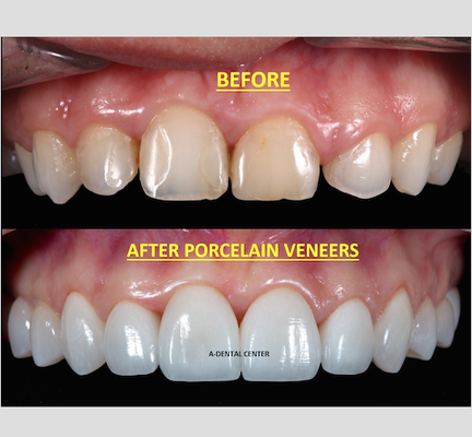 Before and After - Before and After photos of Implants, Crowns, Porcelain Veneers, Inalys, Onlays and Cosmetic Fillings.