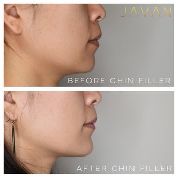 Javan Wellness - Subtle enhancements with chin filler - Medical Spas Near Me - Washington, DC, District of Columbia