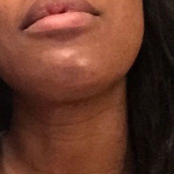 Weston Center for Plastic Surgery - It's not swollen, it's the chin I was left with. - Medical Spas Near Me - Weston, Florida Weston Center for Plastic Surgery - It's not swollen, it's the chin I was left with. - Medical Spas Near Me - Weston, Florida