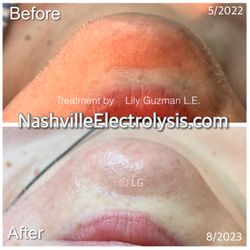 Results : Permanent removal, of course white & red unwanted hair.