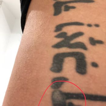 New Look Skin Center - Faded days later in first area of burn - Skin Care Near Me - Encino, California New Look Skin Center - Faded days later in first area of burn - Skin Care Near Me - Encino, California