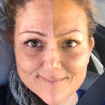 Glow Advanced Skin and Body Care - Before and after - Skin Care Near Me - Temecula, California Glow Advanced Skin and Body Care - Before and after - Skin Care Near Me - Temecula, California