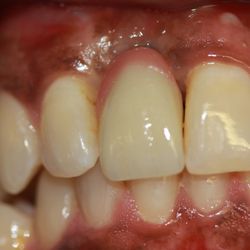 Jacob Elisha, DDS - Southern California Implant Centers - Front tooth implant Zirconia Crown.