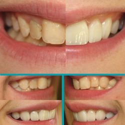 Future of Dentistry - Wakefield - Before and after photos of a patient's veneers.