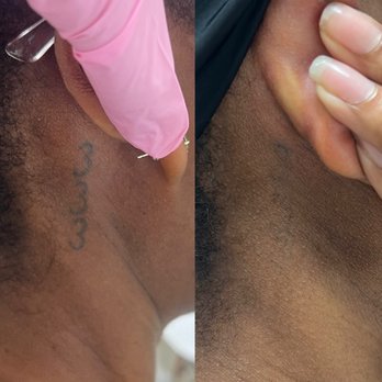 Laser by Nicole - Tattoo removal, after one treatment - Laser Hair Removal Near Me - Weston, Florida Laser by Nicole - Tattoo removal, after one treatment - Laser Hair Removal Near Me - Weston, Florida