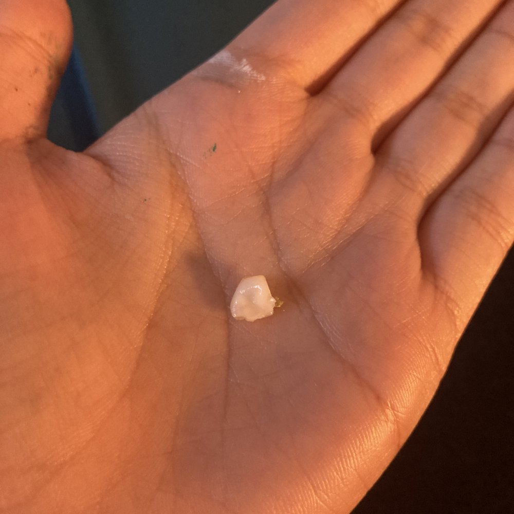 Dominga Bermoy, DDS - This is the piece of my tooth that fell off after 3 months of my check up with Dr. Bermoy - General Dentistry Near Me