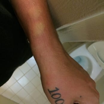 Econo Lodge - Bites on my arm - Hotels Near Me - Calhoun, Georgia Econo Lodge - Bites on my arm - Hotels Near Me - Calhoun, Georgia