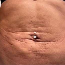 March 25th - you can see theres still a lot of swelling as well as adhesions and deep lines across my stomach March 25th - you can see theres still a lot of swelling as well as adhesions and deep lines across my stomach