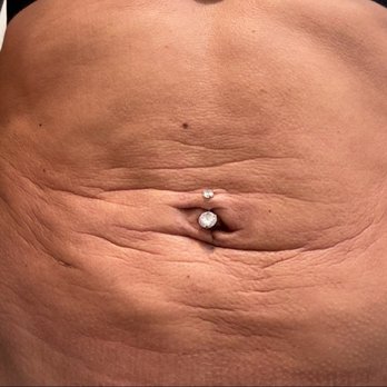Contour Room - March 25th - you can see theres still a lot of swelling as well as adhesions and deep lines across my stomach - Medical Spas Near Me - Agoura Hills, California Contour Room - March 25th - you can see theres still a lot of swelling as well as adhesions and deep lines across my stomach - Medical Spas Near Me - Agoura Hills, California
