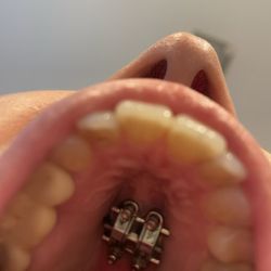 Southern Dental Care - Palette expander. Specially manufactured because I am an adult and have a bridge.