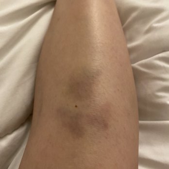 LH Foot Massage - Bruises from the rough massage - Massage Therapy Near Me - Burien, Washington LH Foot Massage - Bruises from the rough massage - Massage Therapy Near Me - Burien, Washington
