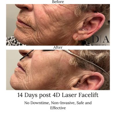 Fotona 4D Facelift - Fotona4D® is an innovative laser treatment that uses a unique combination of 2 complementary laser wavelengths to treat 4 distinct “dimensions” of the skin to rejuvenate and tighten from the inside out. Fotona4D® offers a non-surgical, non-invasive facelift alternative that delivers natural-looking, long-lasting results.
TIGHTENING AND VOLUMIZATION WITHOUT THE NEED FOR FILLERS OR TOXINS
A FULL LIFTING TREATMENT FROM THE INSIDE OUT
IMMEDIATE REJUVENATION, TIGHTENING AND GLOW
IMPROVED SKIN COMPLEXION
LITTLE OR NO DOWNTIME
NO SURGERY, NEEDLES OR ANESTHESIA
