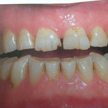 Michael J Mango, DDS - Before Veneers - General Dentistry Near Me - Greensboro, North Carolina Michael J Mango, DDS - Before Veneers - General Dentistry Near Me - Greensboro, North Carolina