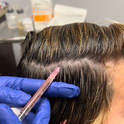 iHealth Medical Weight Loss & Aesthetics - PRP Scalp Injections for Hair Restoration - solution for hair loss & thinning hair! PRP stimulates inactive hair follicles for hair growth