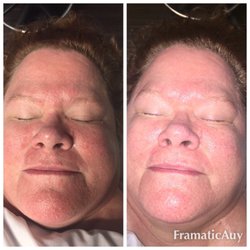 Spa Catalina - After 1 coolift session. Wrinkles reduced in minutes.