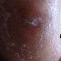 ANTEBI ALON D.O. - SECOND staple found IN leg weeks after surgery and healed over already