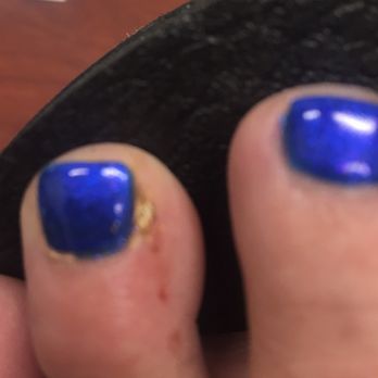 Luxury Nails - Massive cuts -left side below nail, right side, all the way down the toe- that gold stuff is something she put on to stop the bleeding. - Waxing Near Me - Washington, DC, District of Columbia